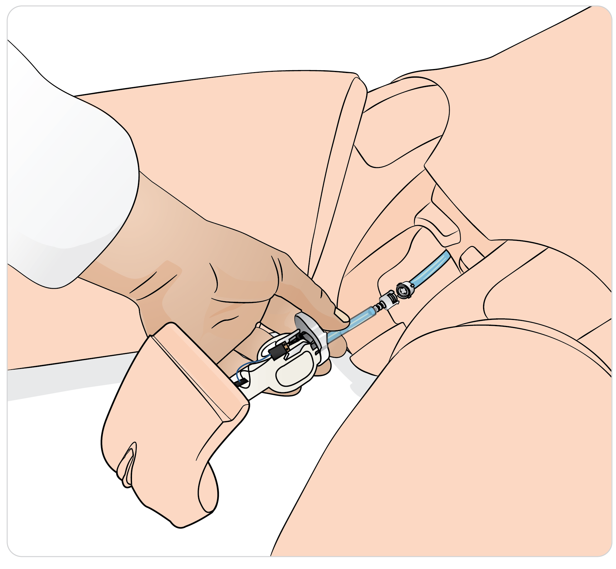 SimManTrauma_DrugArm_Preparing_the_genitalia_and_catheterization_03.png