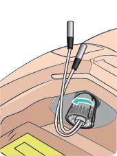 SimMan_Trauma_Old_left_leg3.png