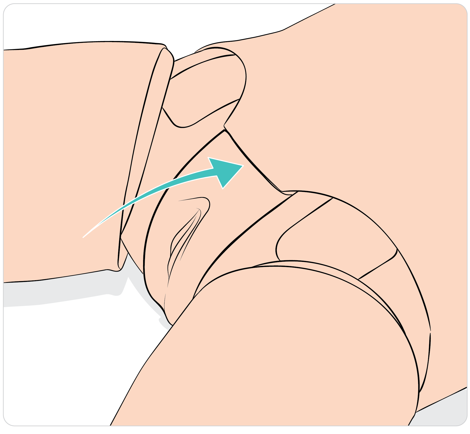 SimManTrauma_DrugArm_Preparing_the_genitalia_and_catheterization_04.png