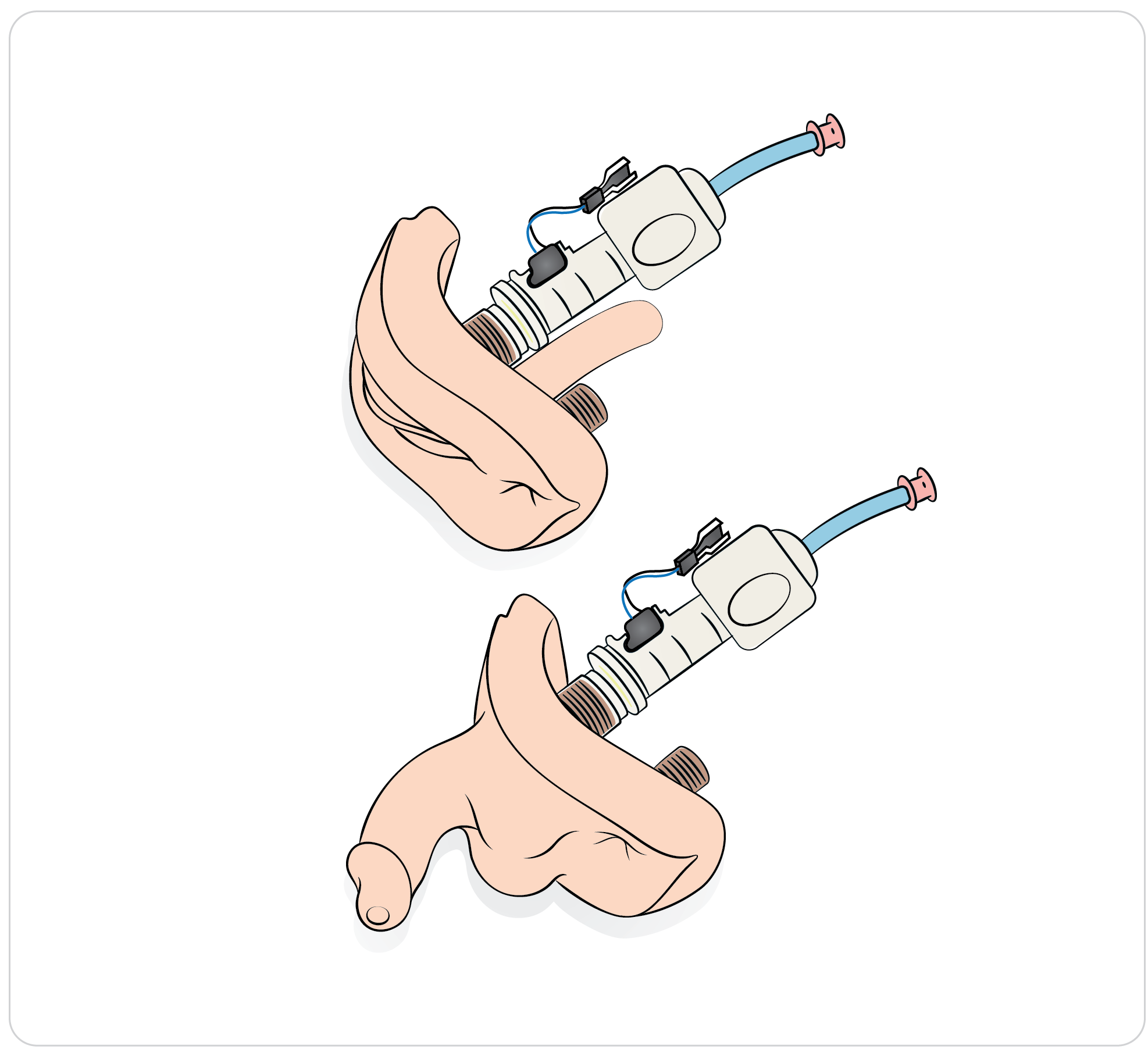 SimManTrauma_DrugArm_Preparing_the_genitalia_and_catheterization_02.png
