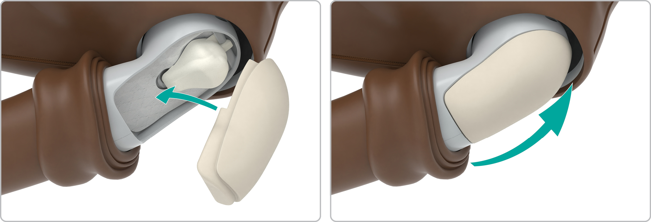 MA_shoulder_pad_in_skin_up.jpg