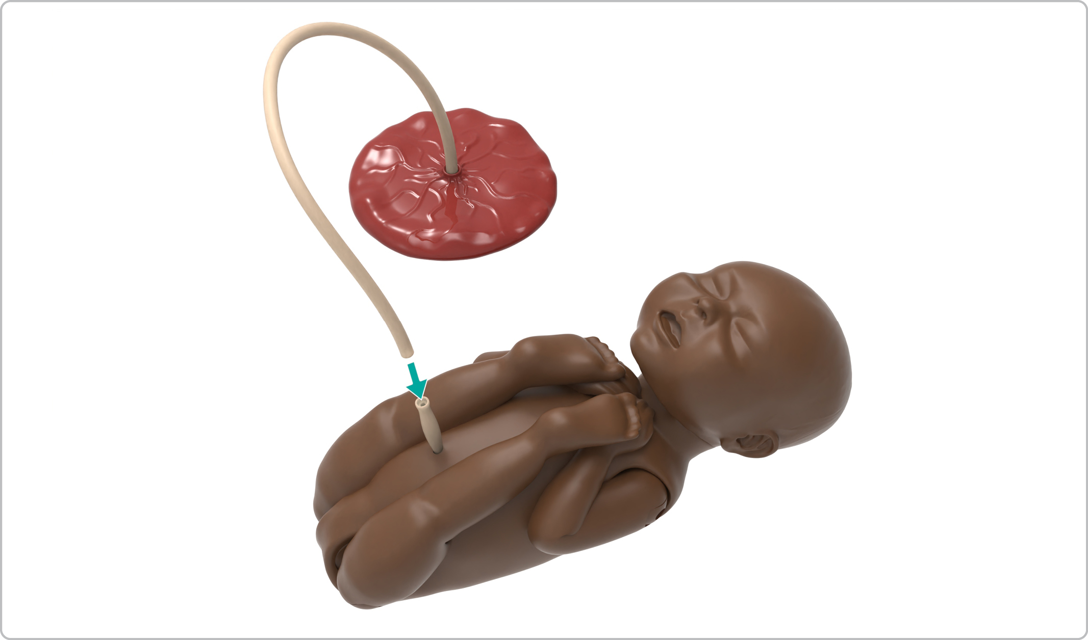 MA_Breech_Placenta_on.jpg